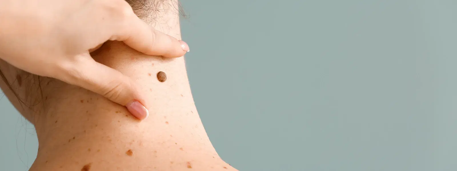 7 Key Differences Between Moles and Beauty Marks