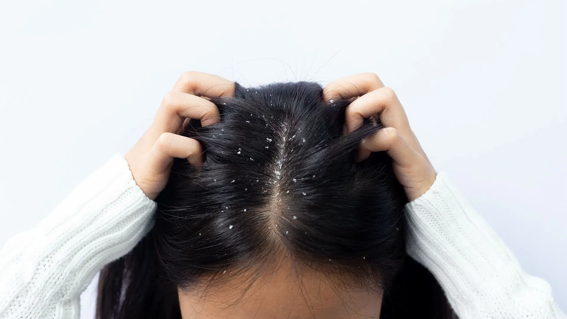 FAQs on Dandruff: Causes, Remedies, and Prevention