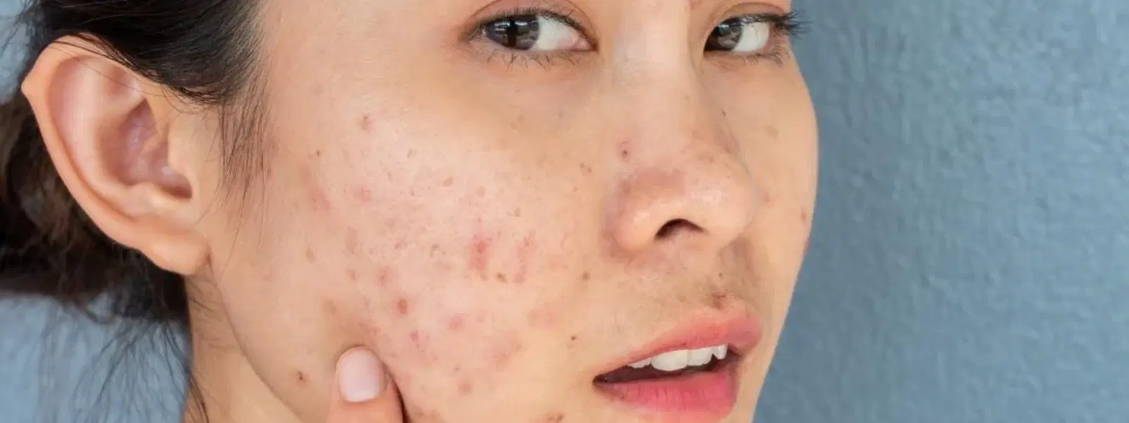 How to Soothe Post-Inflammatory Erythema Effectively