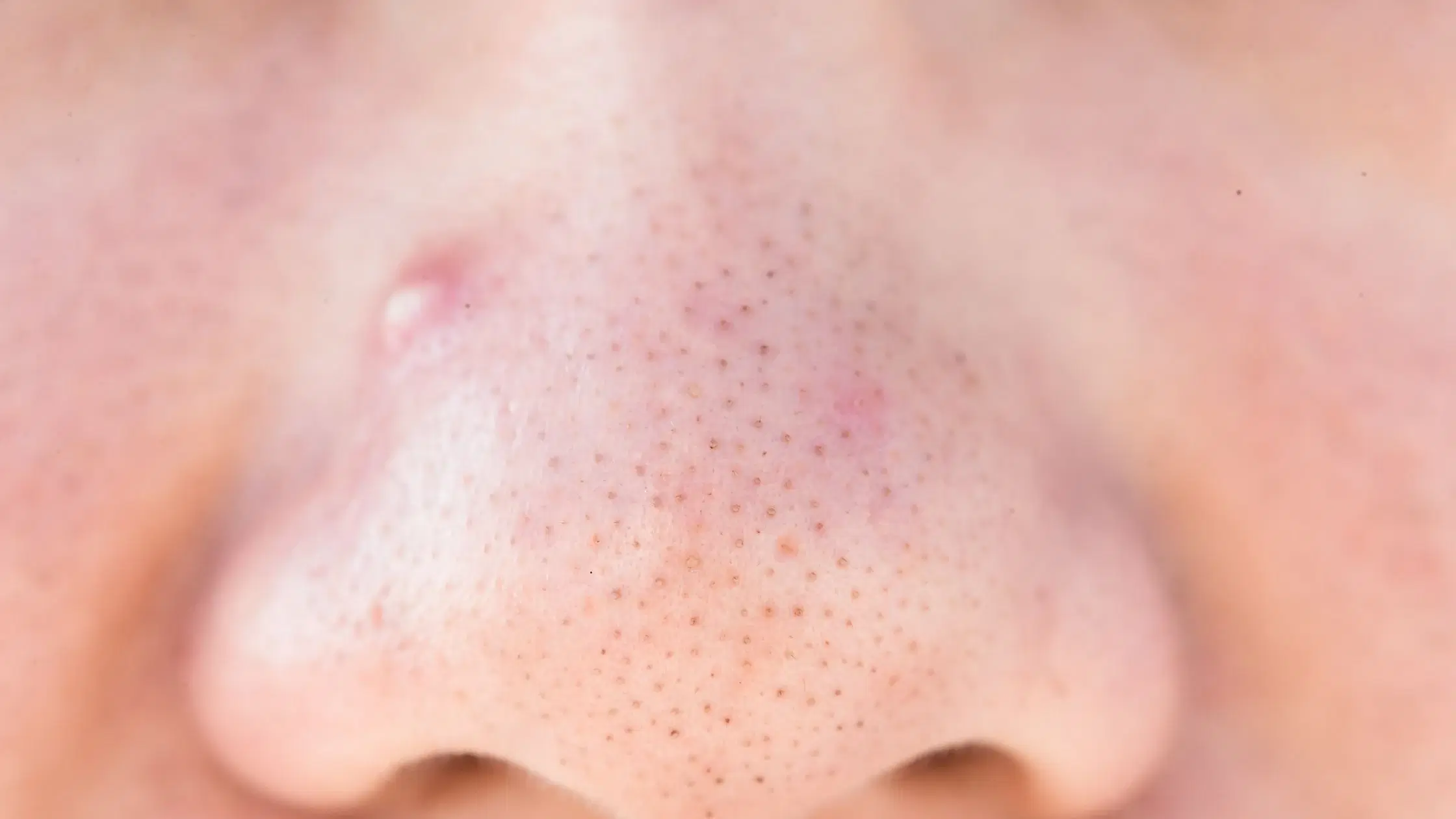 Master Face Mapping: Decode Acne Causes with Your Diet